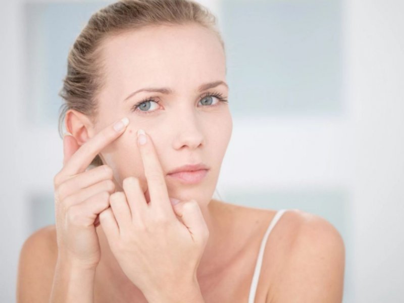 البثور البيضاء&nbsp;