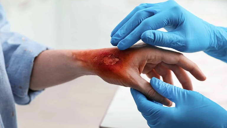 علاج الحروق&nbsp;