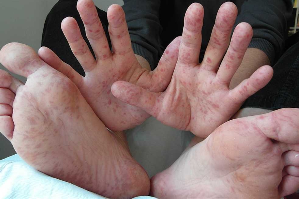 فيروس اليد والقدم والفم&nbsp;