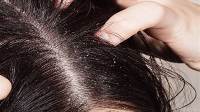طرق تنظيف فروة الشعر بعمق والحد من القشرة
