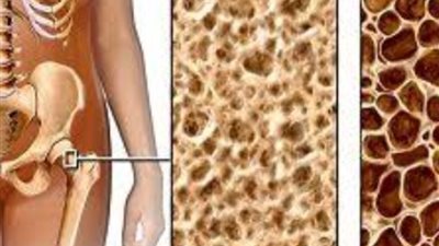 8 طرق للوقاية من هشاشة العظام.. تعرف عليها