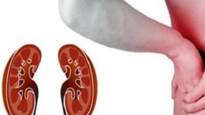 تصيب 37 مليون أمريكى.. كيف تحمي نفسك من الفشل الكلوى المزمن؟