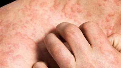 أبرز طرق الوقاية من الطفح الجلدي الناتج عن الجدري.. إليك التفاصيل