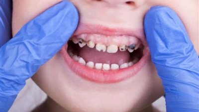منها عدم النظافة.. تعرف على مسببات تسوس الأسنان وطرق العلاج