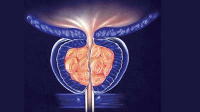 أسباب تضخم البروستاتا عند الرجال.. الأعراض وطرق العلاج
