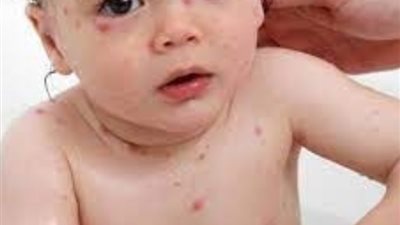 ما لا تعرفه عن الجدري وجدري الماء إليك التفرقة بينهما
