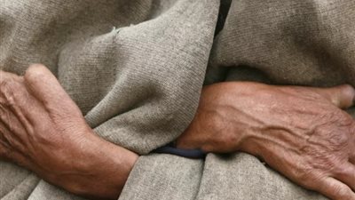 مرض مُعدي.. تعرف على أسباب وأعراض الجذام