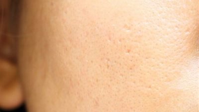 مكعبات الثلج تساعدك على التخلص من المسامات الواسعة