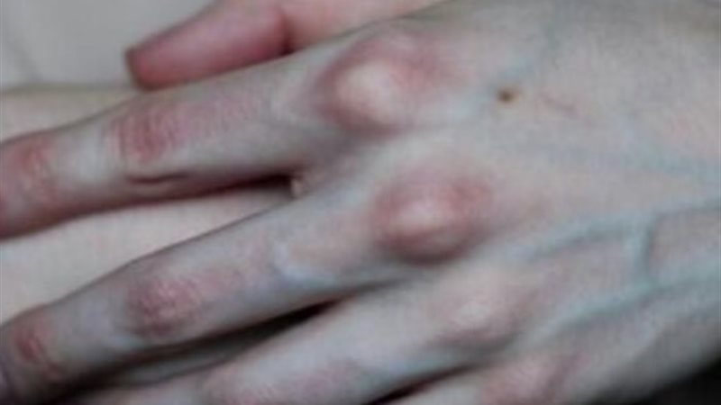 بروز العروق في اليدين