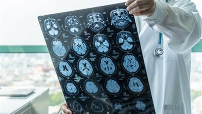 بعد انتهاء مسلسل «الفريدو».. كيف يُخلصنا الذكاء الاصطناعي من الزهايمر؟