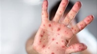 دون الذهاب للطبيب، كيفية علاج جدري القرود؟