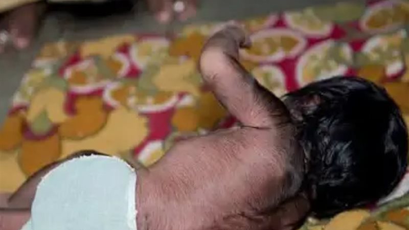 متلازمة الذئب لطفل في إسبانبا