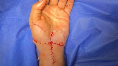 عملية فريدة بقصر العيني، إنقاذ مصاب بزرع يده المبتورة بالكامل