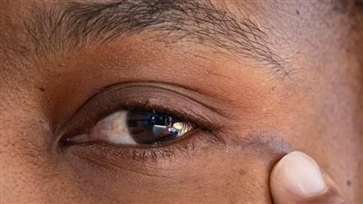 «ثقب المفتاح».. أول عملية جراحية لإزالة ورم بالمخ عبر العين