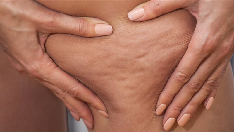 طرق علاج السيلوليت 