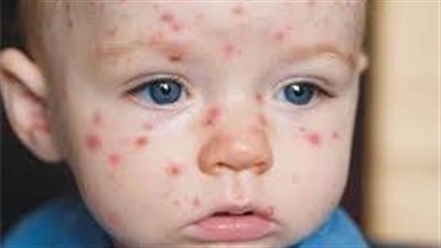  بعد انتشار الحصبة في المغرب، تعرف على طرق الوقاية منها والعلاج