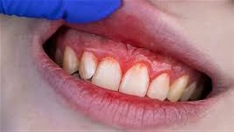 تنظيف الاسنان وعلاقته بالسكتة الدماغية 