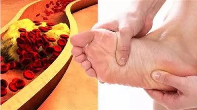 مجدي نزيه: الالتهابات سبب رئيسي لارتفاع الكوليسترول الضار في الجسم