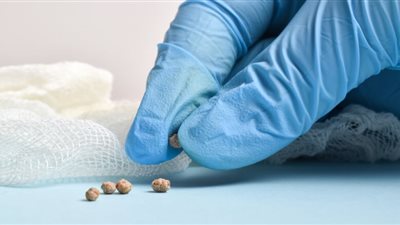 بعد استخراج حصوة تزن 750 جراما من مسن.. ما هو الحجم الطبيعي للحصوات؟