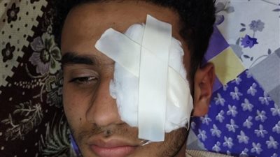 فقد عينه بسبب الشهامة.. شاب يتعرض لإصابة خطيرة على يد آخر بطنطا