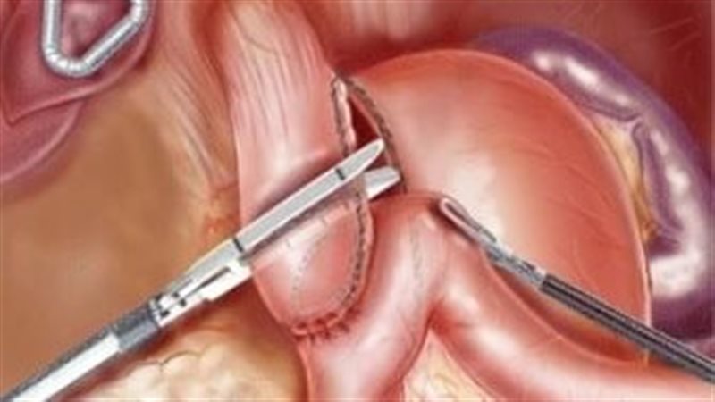 عمليات تكميم االمعدة 