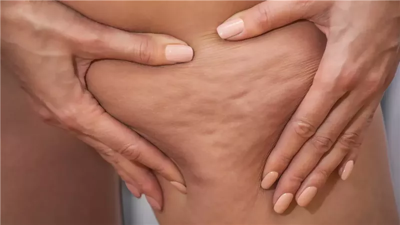 طرق التخلص من السيلوليت 