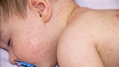 تزامنا مع حرارة الصيف.. 5 خطوات لحماية طفلك من حمو النيل 