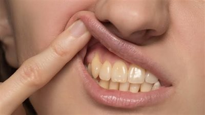 اصفرار الأسنان.. 5 أسباب شائعة تجنّبها لتحافظ على ابتسامتك