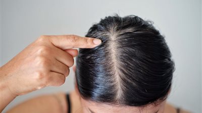 8 حلول ذكية للسيطرة على فروة الرأس الدهنية في الصيف.. تعرفي عليها