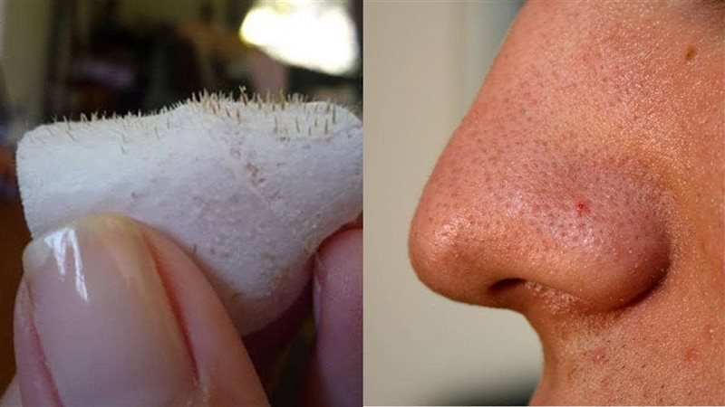 طرق آمنة لتخلص من الرؤوس السوداء