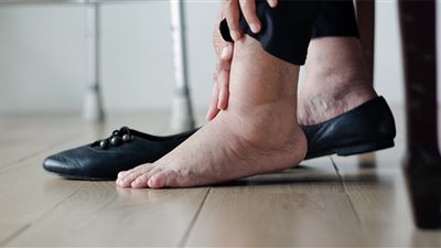 أفضل طرق لعلاج تورم القدمين.. نصائح طبية فعّالة لتفادي المخاطر الصحية