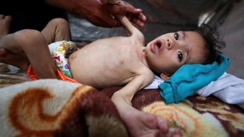 متلازمة غيلان باريه تنتشر بقطاع غزة 