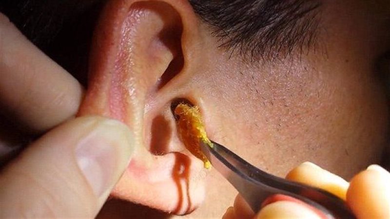 طرق سريعة وآمنة لتنظيف الأذن