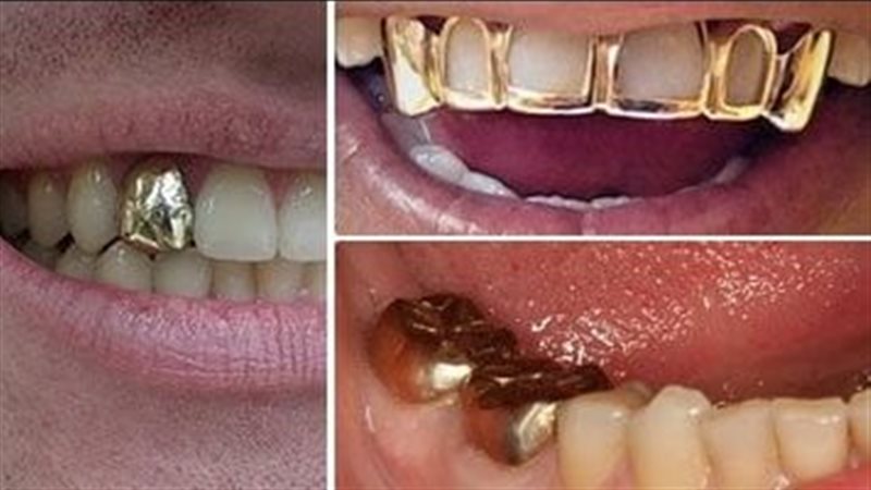 تركيب أسنان من ذهب 