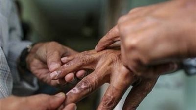 في اليوم العالمي للجذام، تعرف على أسباب وأعراض المرض المنسي