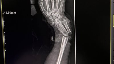 إنقاذ حالتين من بتر مؤكد بإعادة توصيل الأعصاب والشرايين بمستشفى سوهاج الجامعي