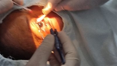 استئناف إجراء عمليات الرمد بمستشفى المنشاة المركزي بعد دعم التجهيزات