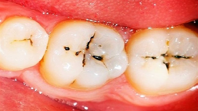 تسوس الأسنان 