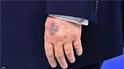 مجدداً ظهور كدمة على يد ترامب يثير التساؤلات.. ما السبب؟