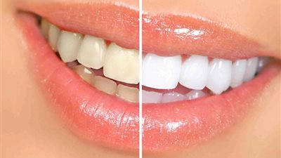 5 وصفات طبيعية لتبييض الأسنان في المنزل