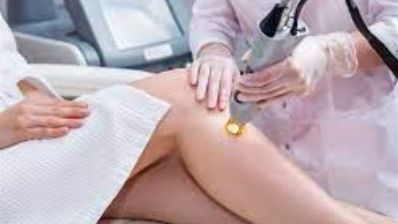 إزالة الشعر بالليزر