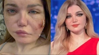 ياسمين الخطيب تخضع لجراحة دقيقة بعد إصابتها بعدوى بكتيرية في الوجه