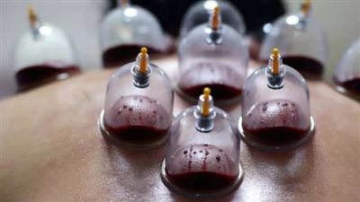 استشاري نفسي: الحجامة قد تُستخدم ضمن برامج علاج بعض الاضطرابات النفسية كعلاج تكميلي