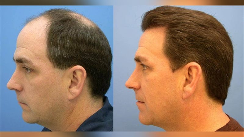 زراعة الشعر