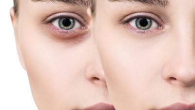 6 خطوت تخلصك من الهالات السوداء، تعرفي عليها